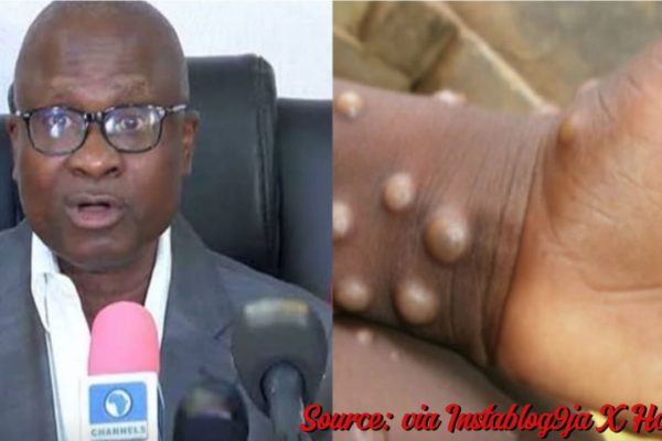 Breaking: Ncdc Reports 39 Mpox Cases In Nigeria With No Death Recorded, Urges Vigilance