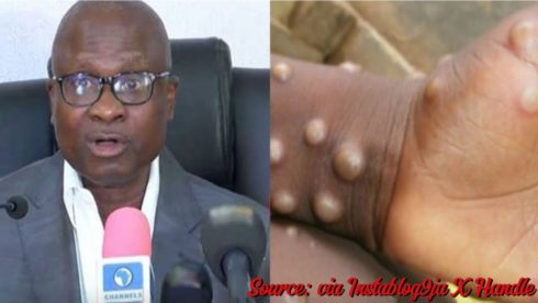 Breaking: Ncdc Reports 39 Mpox Cases In Nigeria With No Death Recorded, Urges Vigilance