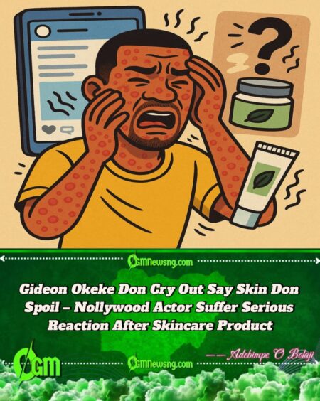 Actor Gideon Okeke Don Shout O! Skin Wahala Dey Worry Am – See Wetin Cause Di Reaction”